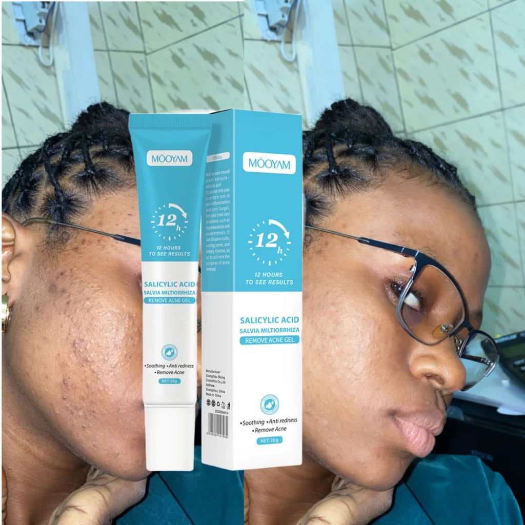 Gel Anti-Acné MÔOYAM à l'Acide Salicylique