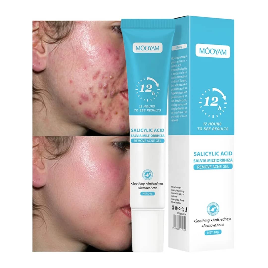 Gel Anti-Acné MÔOYAM à l'Acide Salicylique